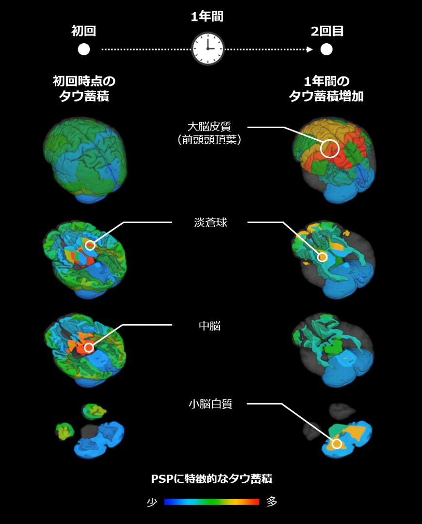 Japanese Research Uses Tau PET to Reveal Association with Symptom Progression in Progressive Supranuclear Palsy